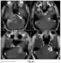 Fig. 18 - METHODS OF TREATING VESTIBULAR SCHWANNOMA