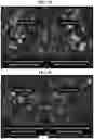 Fig. 08 - Gene therapy for treating peroxisomal disorders