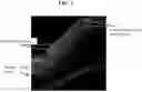 Fig. 10 - Gene therapy for treating peroxisomal disorders