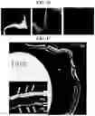 Fig. 18 - Gene therapy for treating peroxisomal disorders