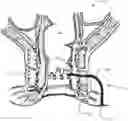 Fig. 01 - METHODS AND MATERIALS FOR TREATING FISTULAS