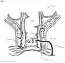 Fig. 02 - METHODS AND MATERIALS FOR TREATING FISTULAS