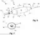 Fig. 05 - Balloon catheter with adjustable inner member