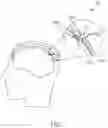 Fig. 02 - Methods and devices for subdural electrode array placement