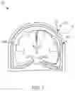 Fig. 09 - Methods and devices for subdural electrode array placement