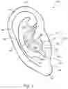 Fig. 02 - Auricular nerve stimulation to address patient disorders, and associated systems and methods