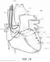 Fig. 16 - Systems and methods for automated capture threshold testing and associated his bundle pacing