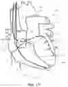 Fig. 18 - Systems and methods for automated capture threshold testing and associated his bundle pacing