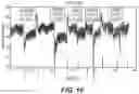 Fig. 13 - Methods and systems for lowering blood pressure through reduction of ventricle filling