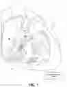 Fig. 02 - Capture in ventricle-from-atrium cardiac therapy