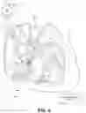 Fig. 05 - Capture in ventricle-from-atrium cardiac therapy