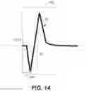 Fig. 15 - Capture in ventricle-from-atrium cardiac therapy
