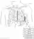 Fig. 01 - Multi-threshold sensing of cardiac electrical signals in an extracardiovascular implantable cardioverter defibrillator