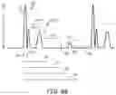 Fig. 12 - Multi-threshold sensing of cardiac electrical signals in an extracardiovascular implantable cardioverter defibrillator