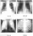 Fig. 09 - Image-guided radiation treatment with imaging data using imaging radiation at different energy levels