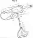 Fig. 07 - Joint separator for body alignment