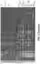 Fig. 06 - GRADING OF BREAST CANCER