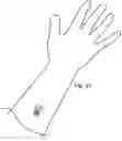 Fig. 20 - Cutaneous information devices and methods to manufacture the same
