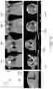 Fig. 16 - Systems and methods for automated distortion correction and/or co-registration of three-dimensional images using artificial landmarks along bones