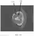 Fig. 14 - Systems and methods for correcting mismatch induced by respiratory motion in positron emission tomography image reconstruction