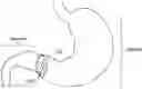 Fig. 01 - INTRAGASTRIC DEVICE WITH EXPANDABLE PORTIONS