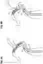 Fig. 09 - Medical implant delivery system and method of use