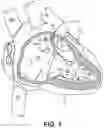 Fig. 02 - MEDICAL DEVICE RETRIEVAL TOOL WITH ADJUSTABLE CURVE