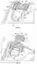 Fig. 07 - Golf club head having stress-reducing features