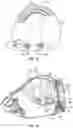 Fig. 10 - Golf club head having stress-reducing features