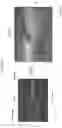 Fig. 09 - Fabrication and applications of multiple side-window, side-firing optical fiber