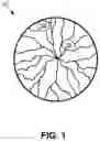 Fig. 02 - Dynamic eye fixation for retinal imaging