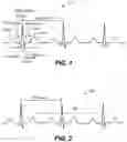 Fig. 02 - Dynamic control of sensitivity associated with detecting R-waves