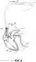 Fig. 06 - Dynamic control of sensitivity associated with detecting R-waves
