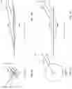 Fig. 02 - INTRA-AORTIC SPIRAL BALLOON PUMP