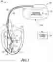 Fig. 02 - His-bundle or bundle branch pacing capture verification