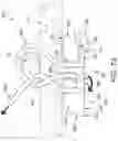 Fig. 71 - METHOD AND APPARATUS FOR CLOSING A FISSURE IN THE ANNULUS OF AN INTERVERTEBRAL DISC, AND/OR FOR EFFECTING OTHER ANATOMICAL REPAIRS AND/OR FIXATIONS