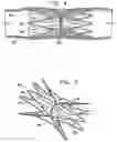 Fig. 03 - Vascular implant
