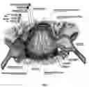 Fig. 02 - Method and apparatus for minimally invasive amelioration of spinal epidural lipomatosis