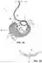 Fig. 02 - Devices, systems, and methods for the treatment of vascular defects