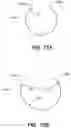 Fig. 21 - Devices, systems, and methods for the treatment of vascular defects