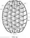 Fig. 35 - Negative pressure wound closure devices and methods