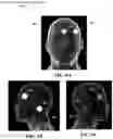 Fig. 13 - METHOD AND SYSTEM TO CHARACTERIZE DISEASE USING PARAMETRIC FEATURES OF A VOLUMETRIC OBJECT AND MACHINE LEARNING