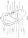 Fig. 02 - Open-canal in-ear device