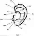 Fig. 11 - EXTERNAL EAR INSERT FOR HEARING ENHANCEMENT