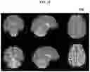 Fig. 19 - Method and program for navigating TMS stimulation