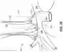 Fig. 06 - Electrode assemblies for neurostimulation treatment