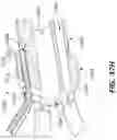 Fig. 78 - Electrode assemblies for neurostimulation treatment