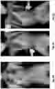Fig. 05 - MEDICAL DEVICE FOR APPLYING PRESSURE TO A HUMAN JOINT SEGMENT, CORRESPONDING SYSTEM, ASSOCIATED METHOD AND USES