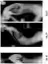 Fig. 06 - MEDICAL DEVICE FOR APPLYING PRESSURE TO A HUMAN JOINT SEGMENT, CORRESPONDING SYSTEM, ASSOCIATED METHOD AND USES