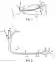 Fig. 02 - COAPTATION ULTRASOUND DEVICES AND METHODS OF USE